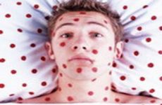 Симптомы и лечение кори у детей